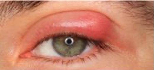 Chalazion - vlčí zrno, je zánět žlázky v hloubce víčka.